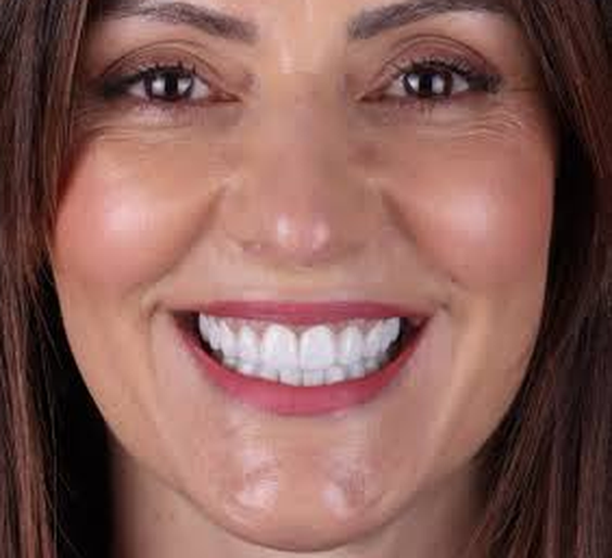 Facetas Dentárias